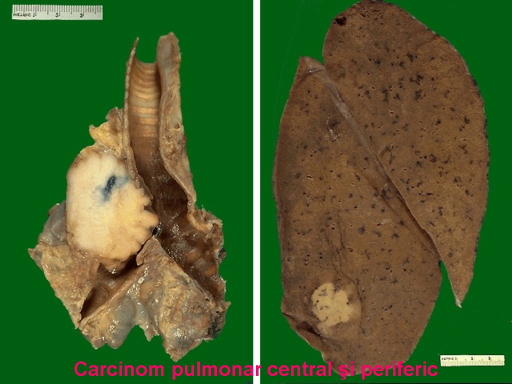 Carcinom pulmonar central şi periferic
